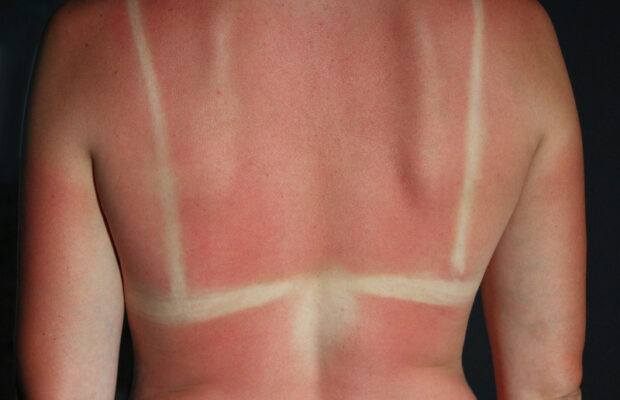 Feeling the burn? ☀ Try this!